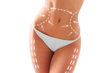 Lipoescultura