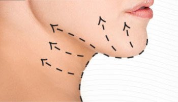 Liposuccion de Cuello