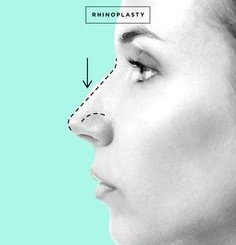 Rinoplastia